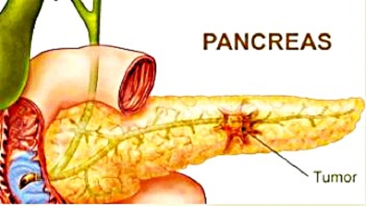 UNO DE LOS CÁNCERES MÁS AGRESIVOS Y LETALES pancreas