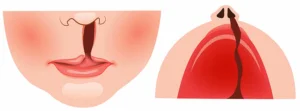 DEMUESTRAN EFECTIVIDAD DE CÉLULAS TRONCALES DE SANGRE DE CORDÓN UMBILICAL PARA TRATAR LABIO Y PALADAR HENDIDO EN BEBÉS.
